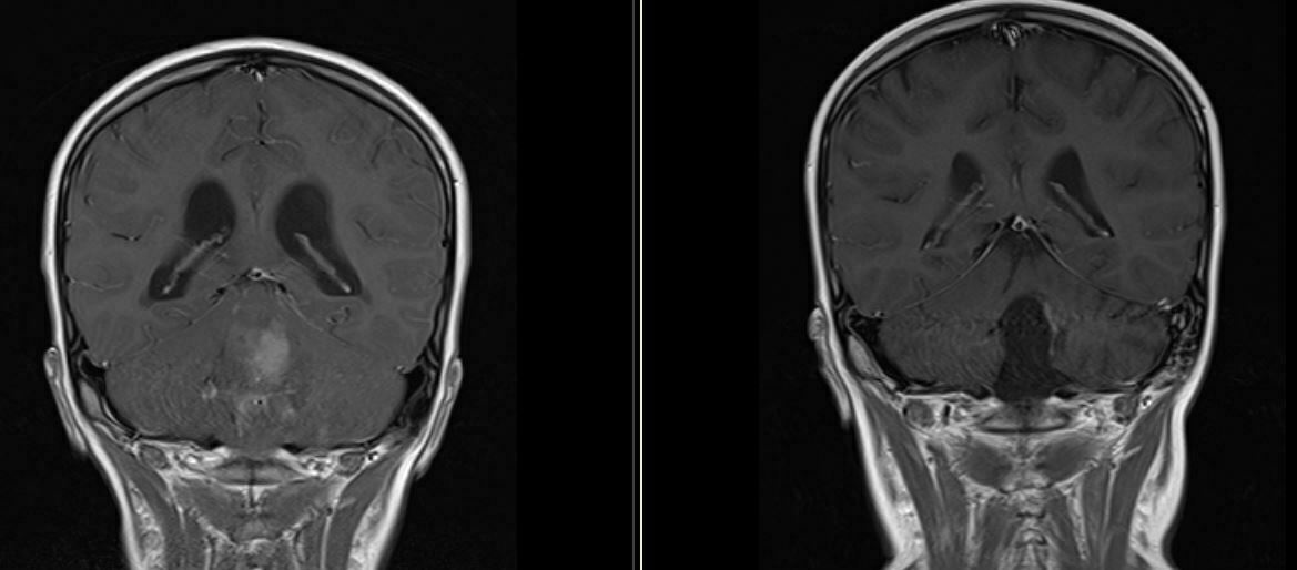 Μυελοβλάστωμα, Medulloblastoma, Μαγνητική Τομογραφία, MRI